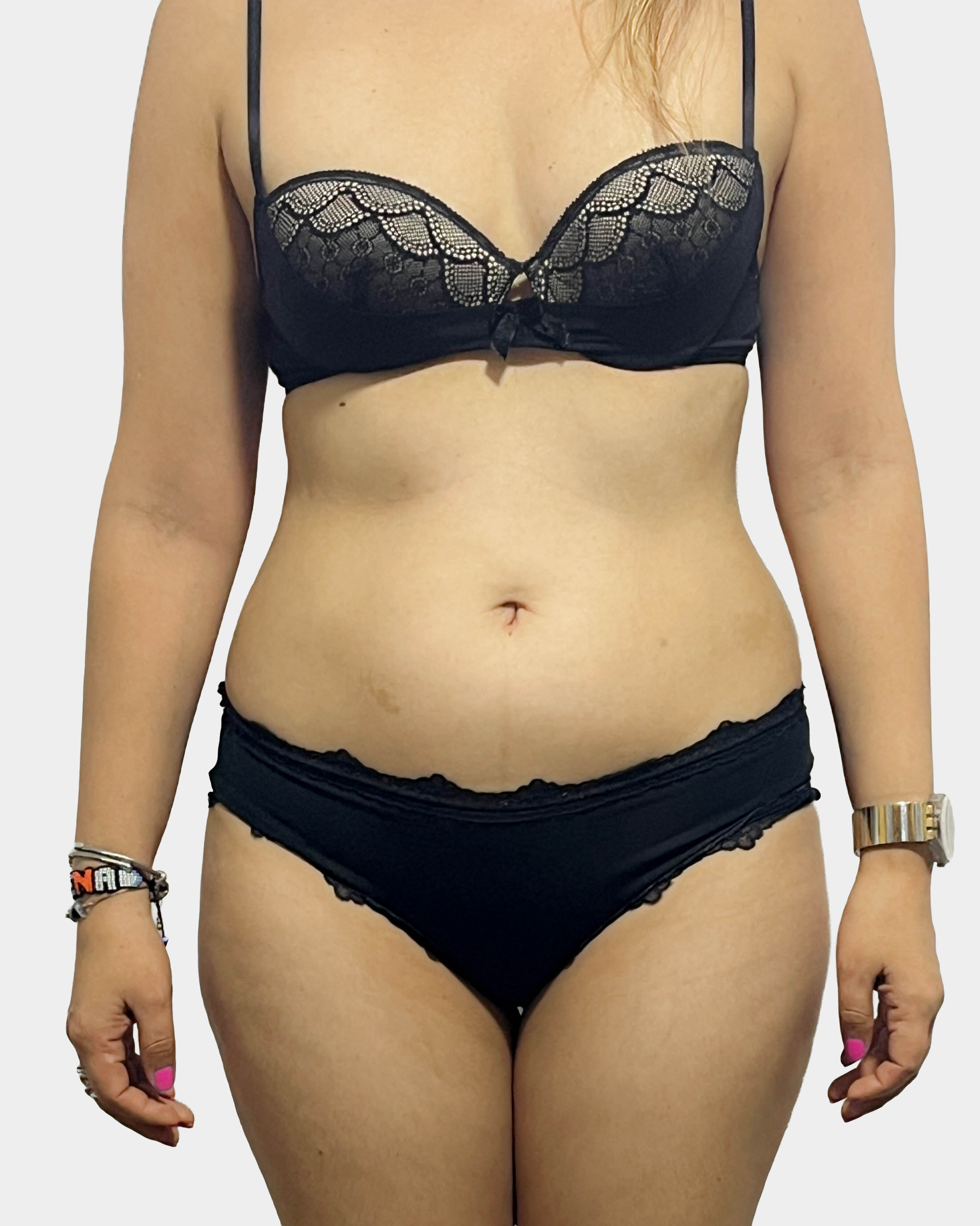 Antes de Reducción y Moldeo